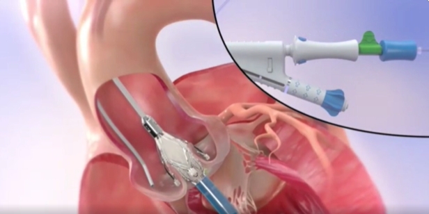 Taurustrio ™反流适应证TAVR系统完成多中心注册临床全部患者入组